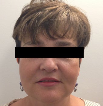54 year old woman who underwent ThermiLift of the jawline and neck. after 1417732