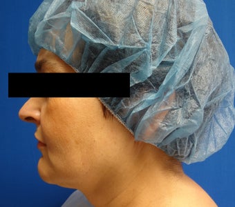 54 year old woman who underwent ThermiLift of the jawline and neck. 1417732