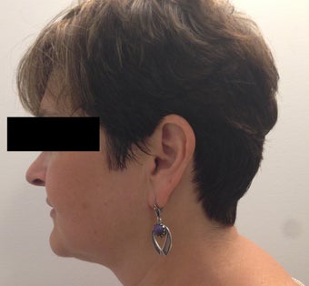 54 year old woman who underwent ThermiLift of the jawline and neck. 1417732