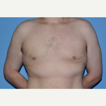 Bilateral Gynecomastia Correction after 2969819