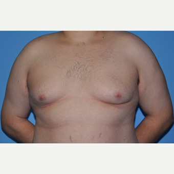 Bilateral Gynecomastia Correction before 2969819