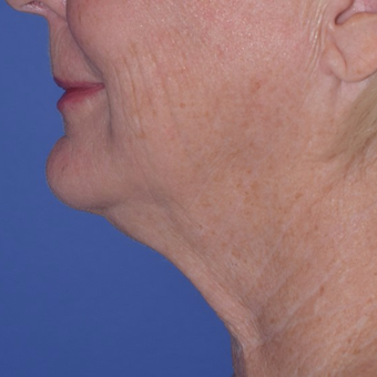 65-74 year old woman treated with Laser-Assisted Liposuction before 3154225