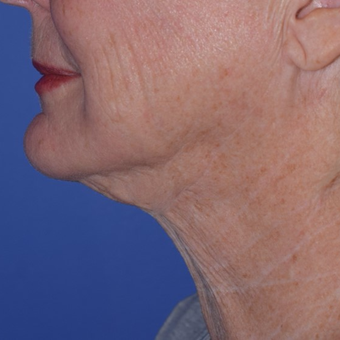 65-74 year old woman treated with Laser-Assisted Liposuction after 3154225