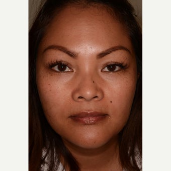 Belotero for undereye hollows and dark circles before 1787629