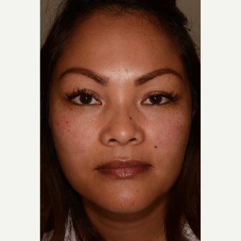 Belotero for undereye hollows and dark circles after 1787629