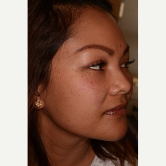 Belotero for undereye hollows and dark circles 1787629