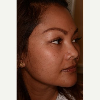 Belotero for undereye hollows and dark circles 1787629