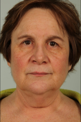 63 year old woman treated with Facelift before 3440229