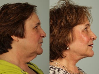 63 year old woman treated with Facelift 3440229