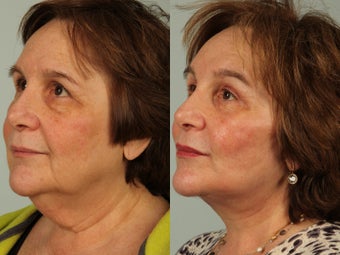 63 year old woman treated with Facelift 3440229