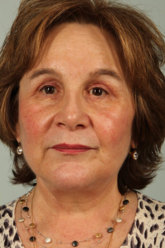 63 year old woman treated with Facelift after 3440229