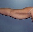 42 year old female patient 927042