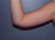 42 year old female patient 927042