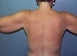 42 year old female patient before 927042