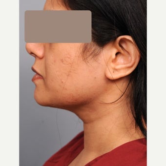 Chin Liposuction 35-44 year old woman after 1674804