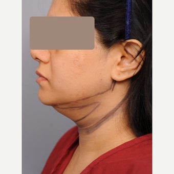 Chin Liposuction 35-44 year old woman before 1674804