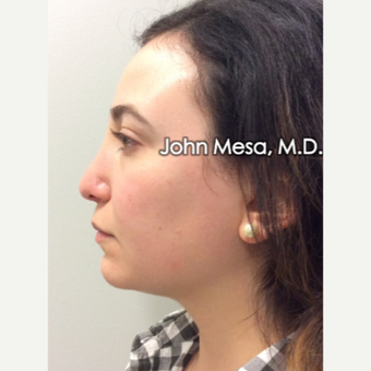 25-34 year old woman treated with Buccal Fat Removal before 3769138