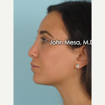 25-34 year old woman treated with Buccal Fat Removal after 3769138