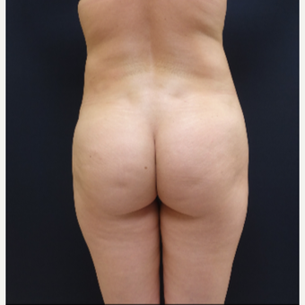 25-34 year old woman treated with Brazilian Butt Lift Revision with 712cc Butt Implants before 3259416