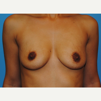 27 year old woman treated with Breast Implants, saline, B to full C cup, high profile before 3624258