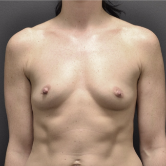25-34 year old woman treated with Breast Augmentation before 3737521
