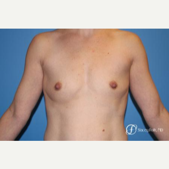 25-34 year old woman treated with Breast Augmentation before 3186316