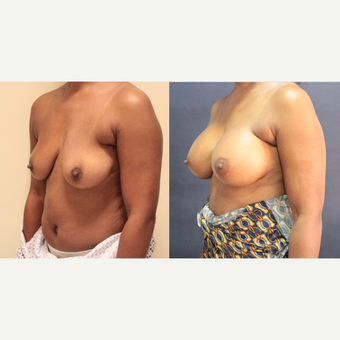 42 year old woman treated with Breast Augmentation before 3073872