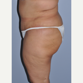 35-44 year old woman treated with Tummy Tuck after 3584293