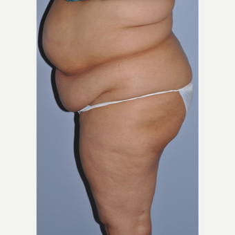 35-44 year old woman treated with Tummy Tuck before 3584293