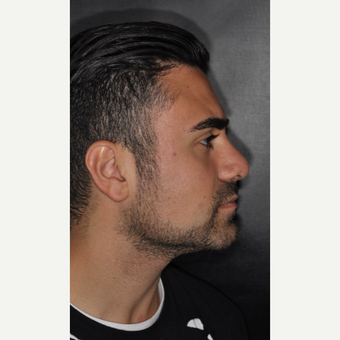 18-24 year old man treated with Nose Surgery 6 weeks post-op after 3500204