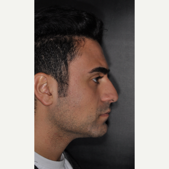 18-24 year old man treated with Nose Surgery 6 weeks post-op before 3500204