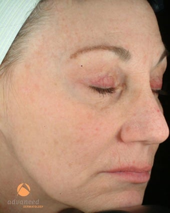 Female treated with 3 Photodynamic Therapy with Levulan for sun damage after 1041644