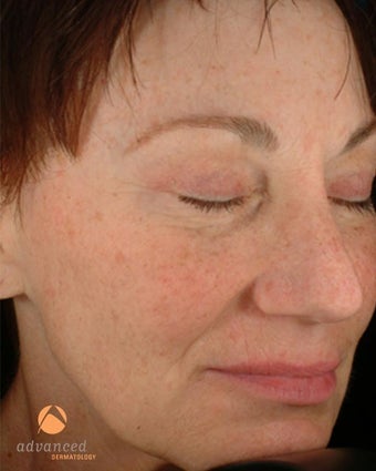 Female treated with 3 Photodynamic Therapy with Levulan for sun damage before 1041644