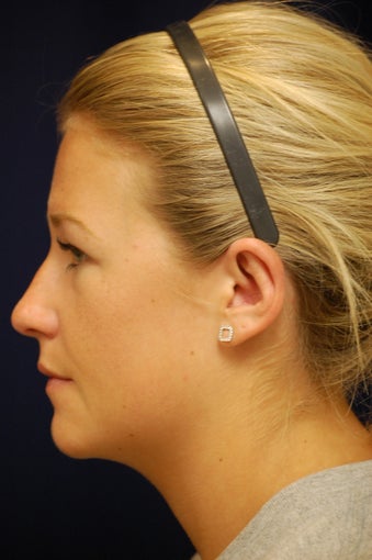 18-24 year old woman treated with Ear Surgery 3240463
