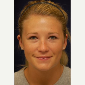 18-24 year old woman treated with Ear Surgery after 3240463