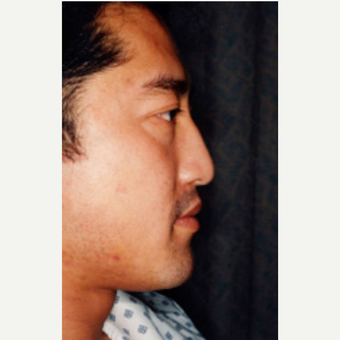 35-44 year old man treated with Rhinoplasty before 3242536