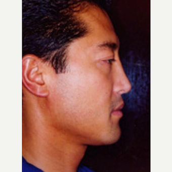 35-44 year old man treated with Rhinoplasty after 3242536