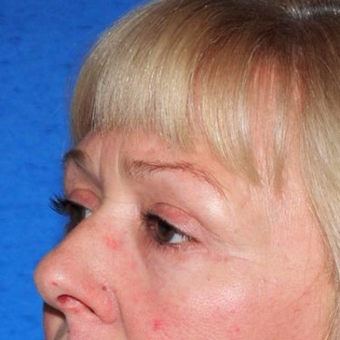 45-54 year old woman treated with Eyelid Surgery after 3497027