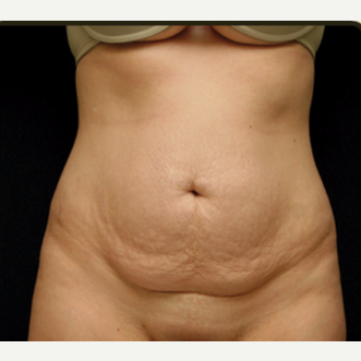 25-34 year old woman treated with Tummy Tuck before 3529217