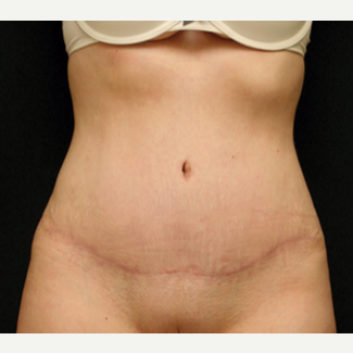 25-34 year old woman treated with Tummy Tuck after 3529217