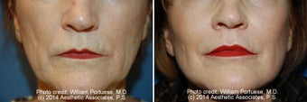 Dermabrasion before 1385290
