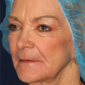 67 year old woman treated one time with Laser Peel after 3630336