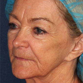 67 year old woman treated one time with Laser Peel before 3630336
