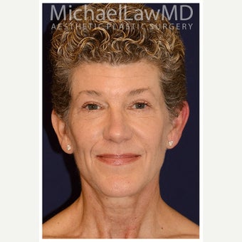 55-64 year old woman treated with Fat Transfer after 1586070