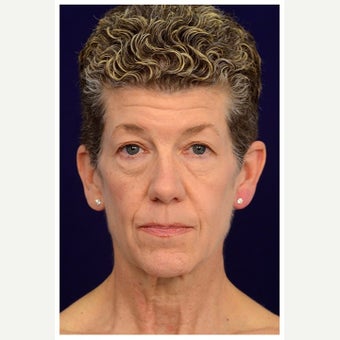 55-64 year old woman treated with Fat Transfer before 1586070