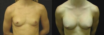 20 year old woman treated with Breast Augmentation before 2990248