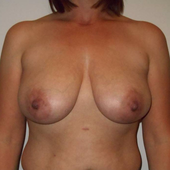 35-44 year old woman treated with Breast Lift before 3407984