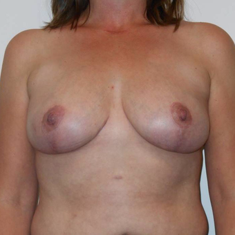 35-44 year old woman treated with Breast Lift after 3407984