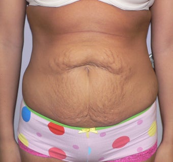 31 year old woman has Tummy Tuck before 990597