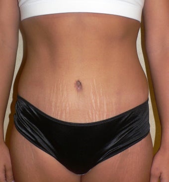 31 year old woman has Tummy Tuck after 990597